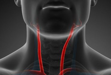 Closure of the carotid artery